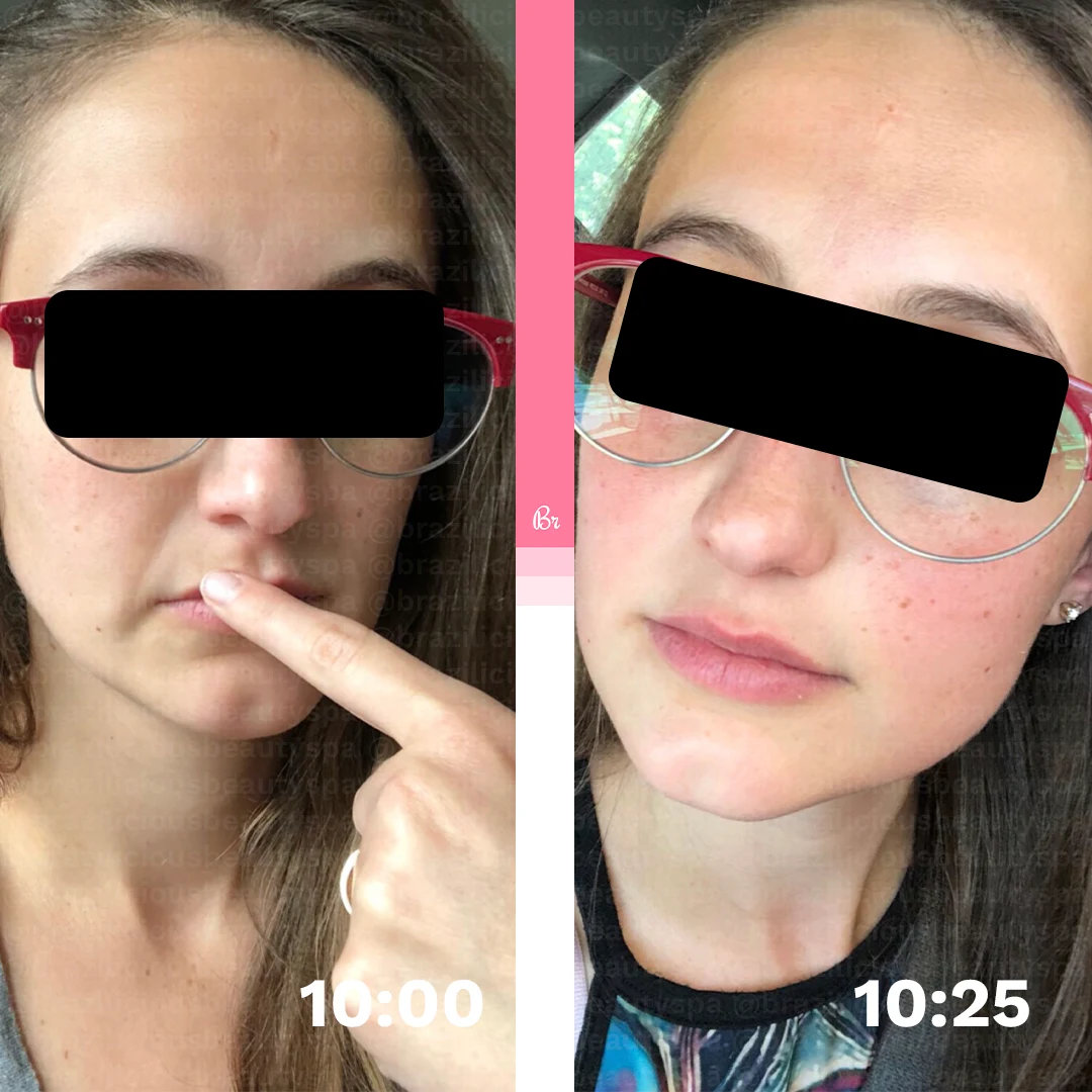 Before and After - Face