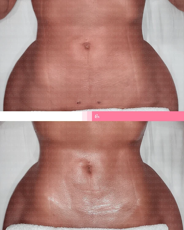 Before and After - Post Surgery 1