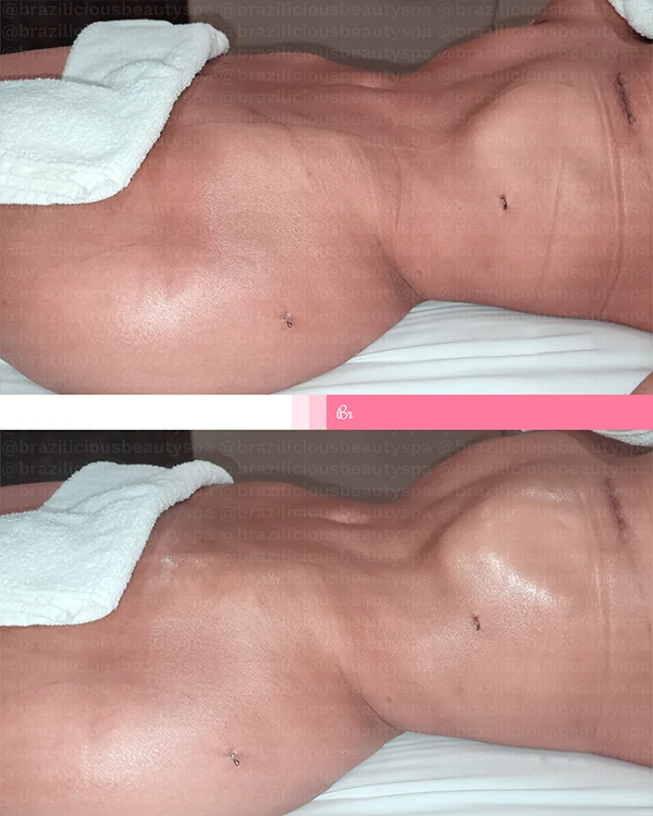 Before and After - Post Surgery 2