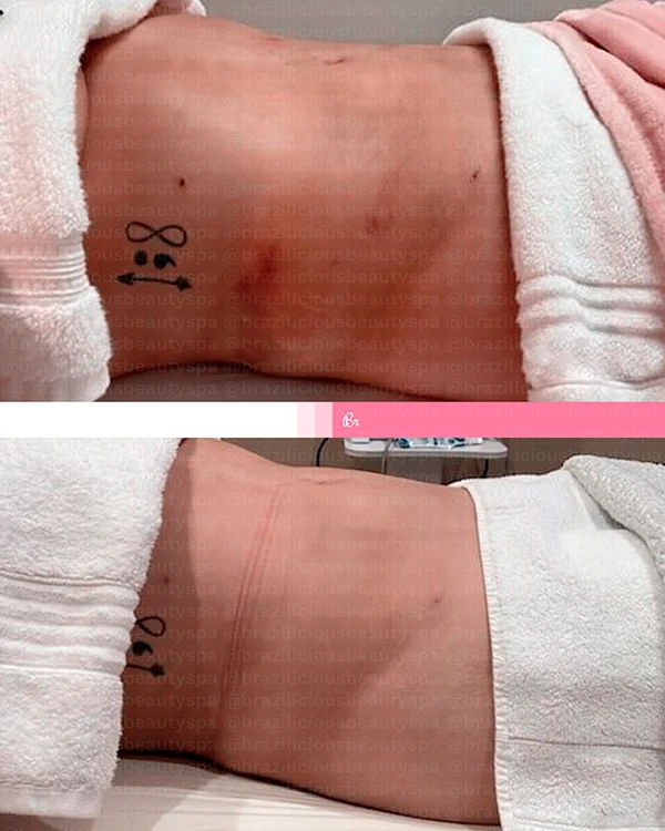 Before and After - Post Surgery 4