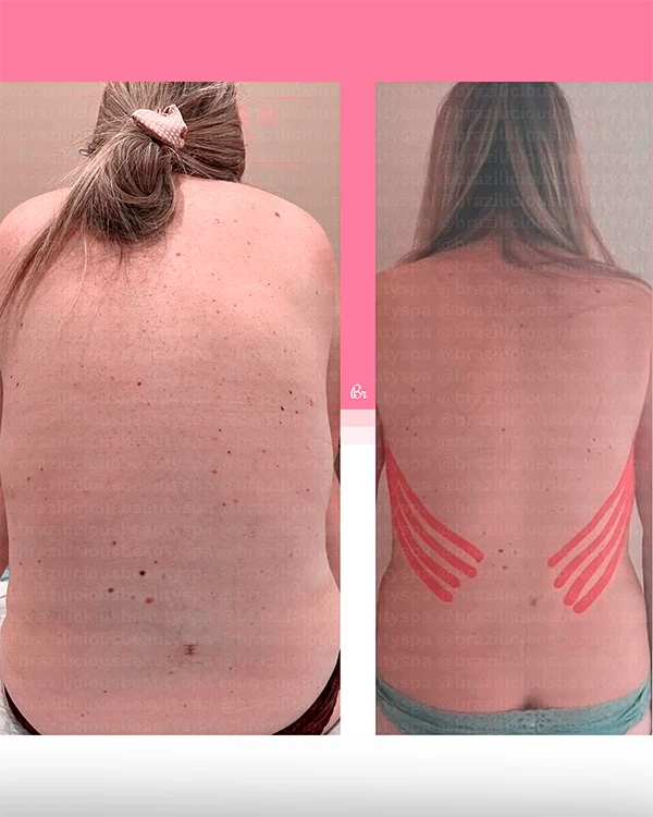 Before and After - Post Surgery 5
